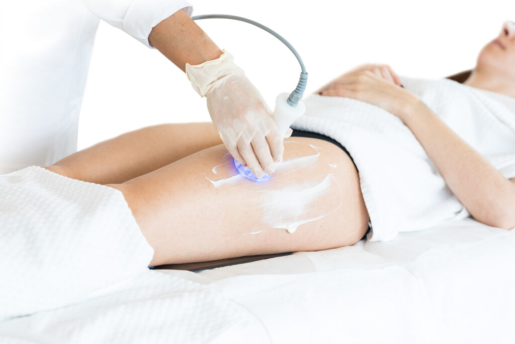 Trattamento di radiofrequenza su coscia donna